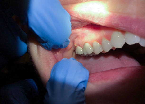 Best Emergency Dentist for Lost Fillings or Crowns in Ashland, WI